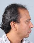 Before Hair Transplant&nbsp;Front